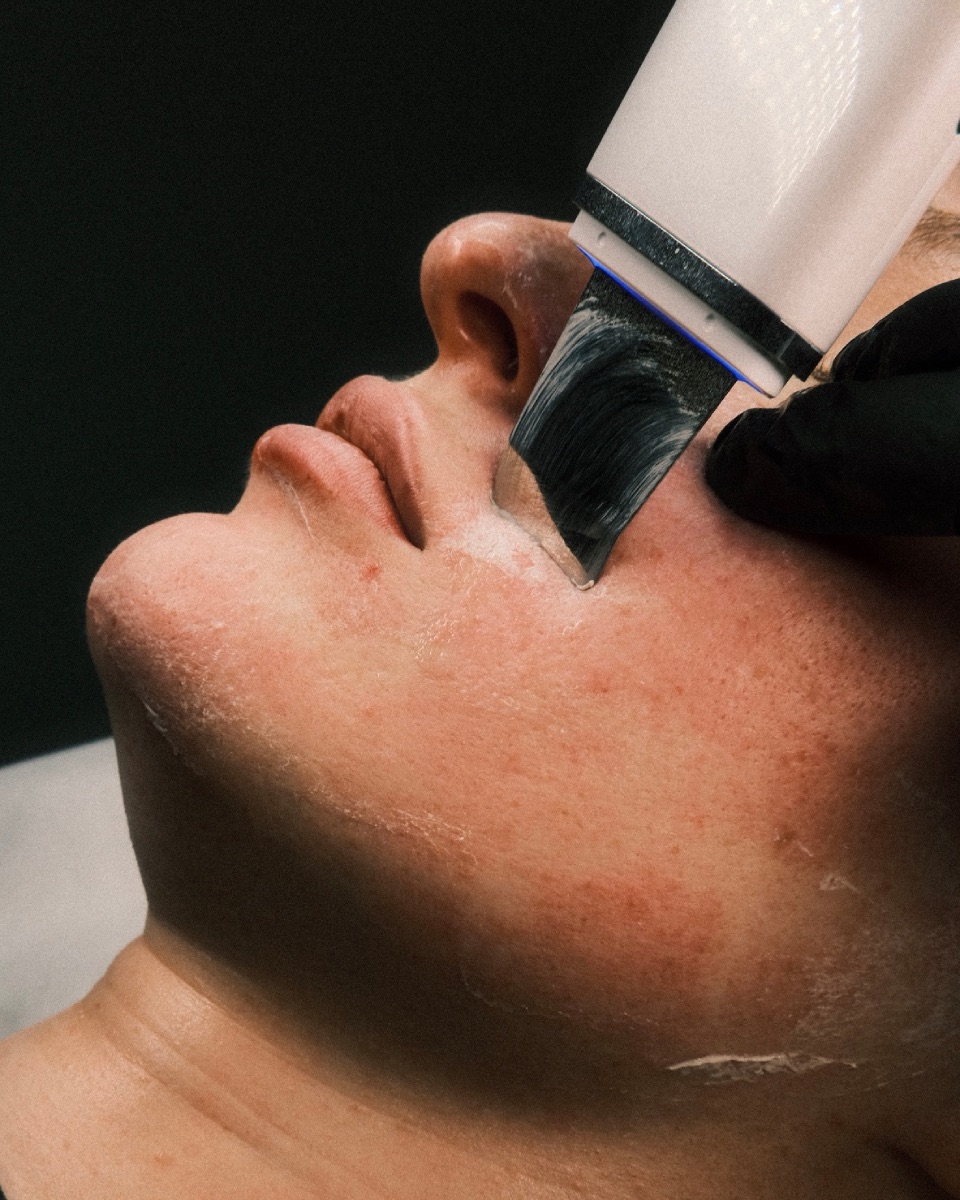 Acne scars treatment for post-acne marks in Manhattan