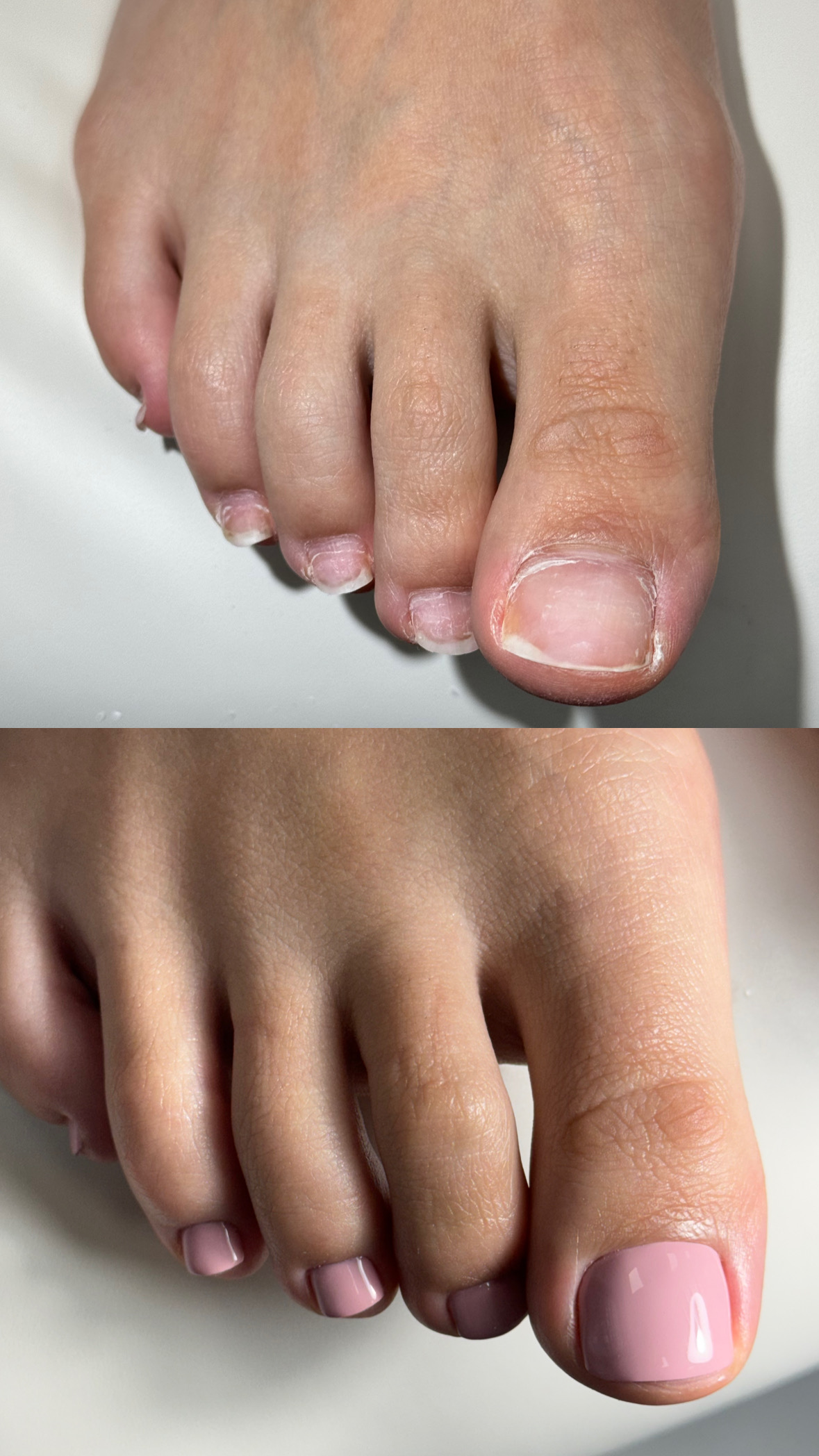 Before and after SMART Pedicure result in NYC