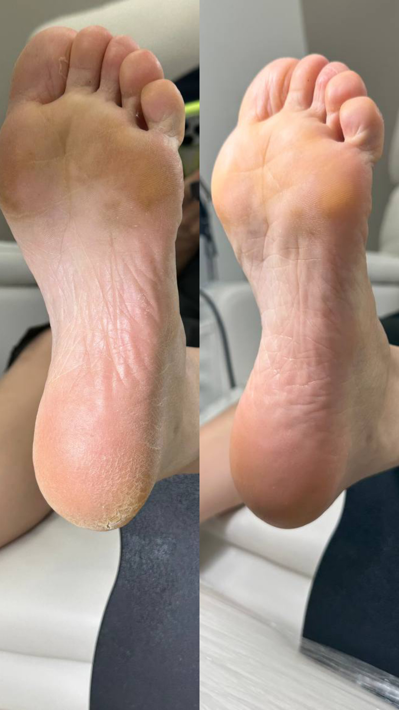 Heel Cleaning for dry heel skin in NoMad, Manhattan