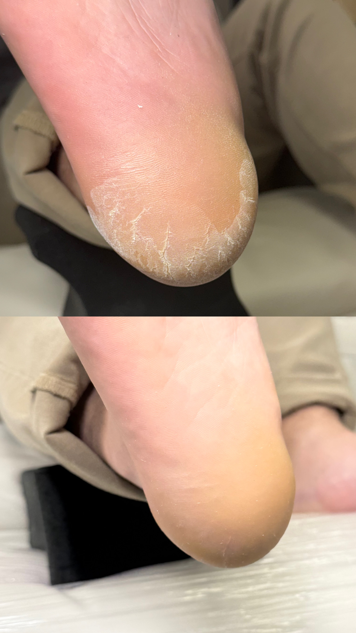 Cosmetic heel cleaning and foot care in NYC