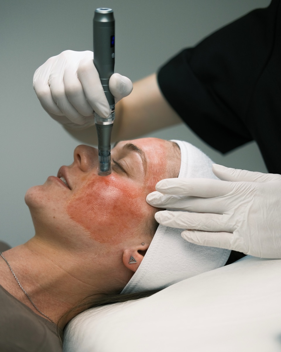 Microneedling with exosomes near NoMad, Manhattan