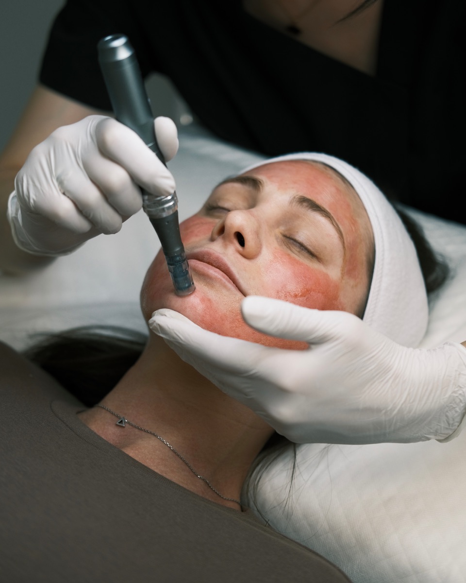 Microneedling with Salmon DNA near NoMad, Manhattan